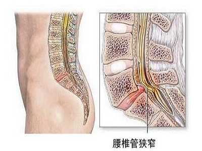 腰椎管狭窄